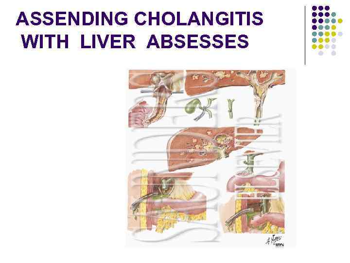 ASSENDING CHOLANGITIS WITH LIVER ABSESSES 