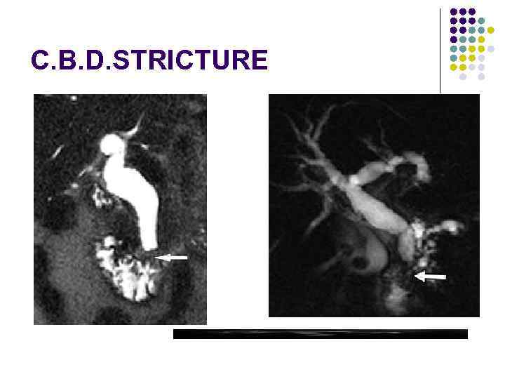 C. B. D. STRICTURE 