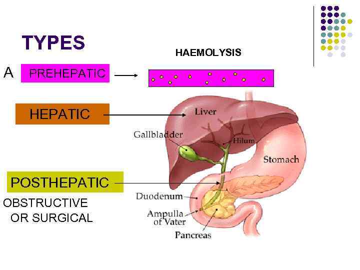 TYPES A PREHEPATIC POSTHEPATIC OBSTRUCTIVE OR SURGICAL HAEMOLYSIS 