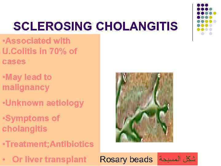 SCLEROSING CHOLANGITIS • Associated with U. Colitis in 70% of cases • May lead