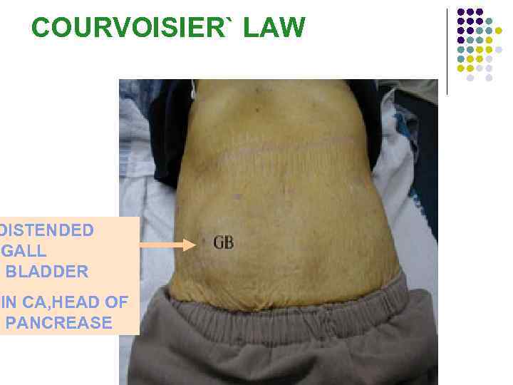 COURVOISIER` LAW DISTENDED GALL BLADDER IN CA, HEAD OF PANCREASE 