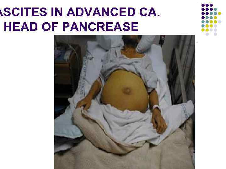 ASCITES IN ADVANCED CA. HEAD OF PANCREASE 