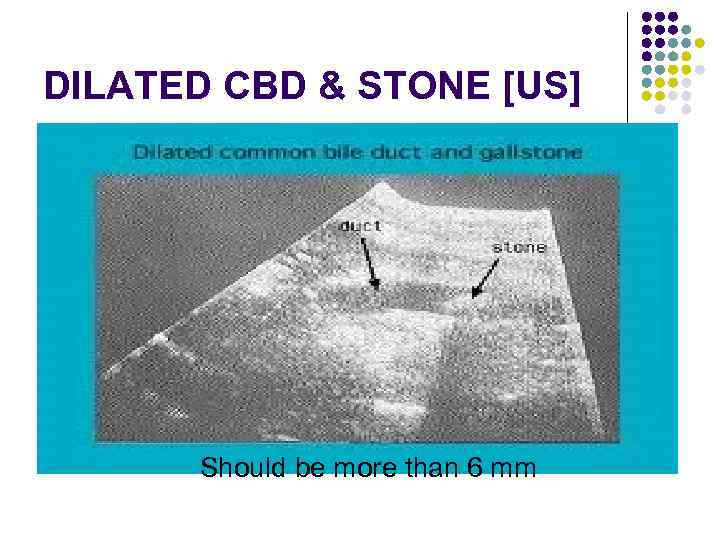 DILATED CBD & STONE [US] Should be more than 6 mm 