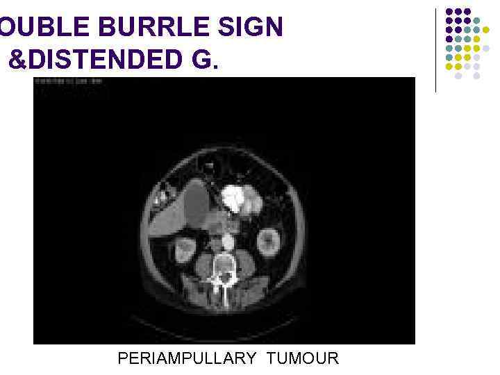 OUBLE BURRLE SIGN &DISTENDED G. PERIAMPULLARY TUMOUR 