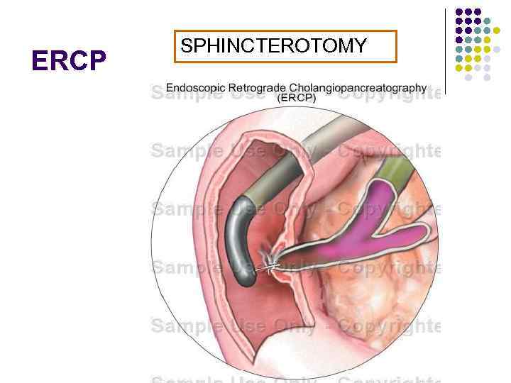 ERCP SPHINCTEROTOMY 