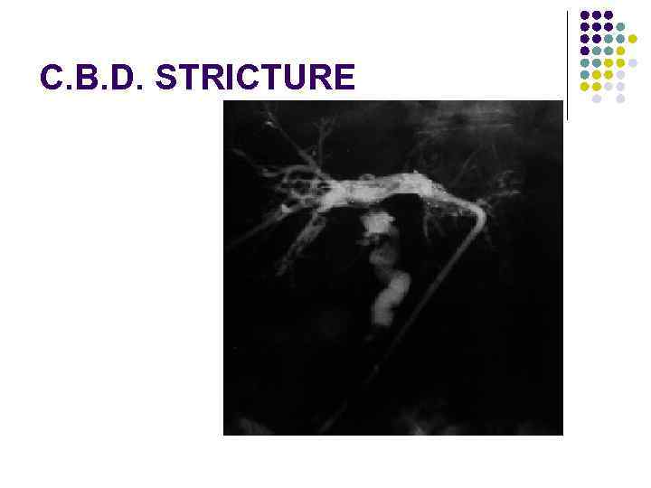 C. B. D. STRICTURE 