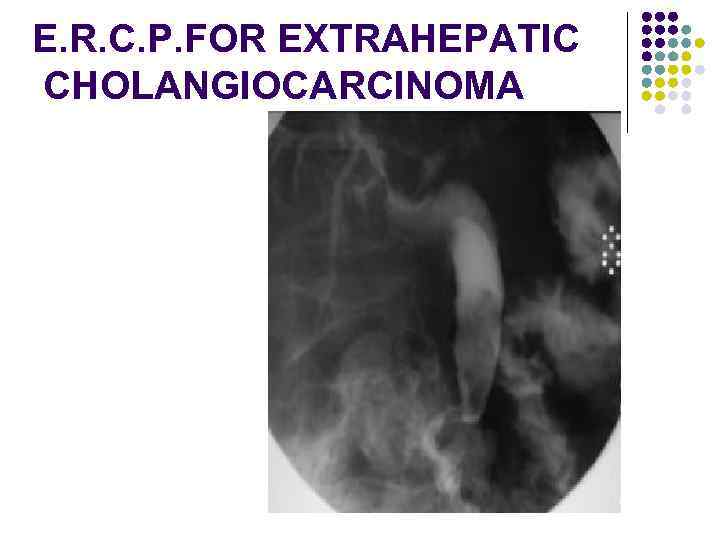 E. R. C. P. FOR EXTRAHEPATIC CHOLANGIOCARCINOMA 