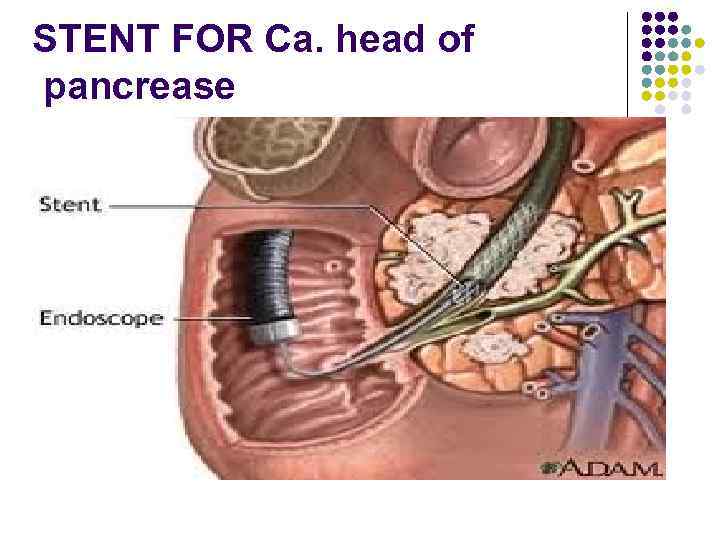 STENT FOR Ca. head of pancrease 