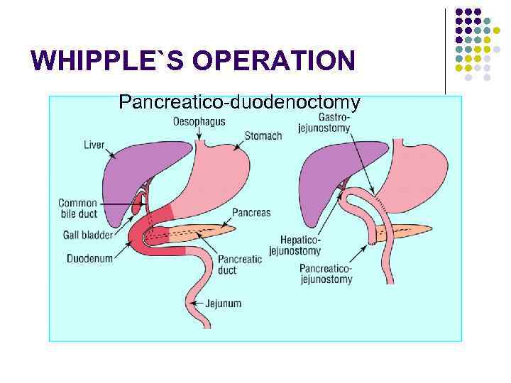 WHIPPLE`S OPERATION Pancreatico-duodenoctomy 