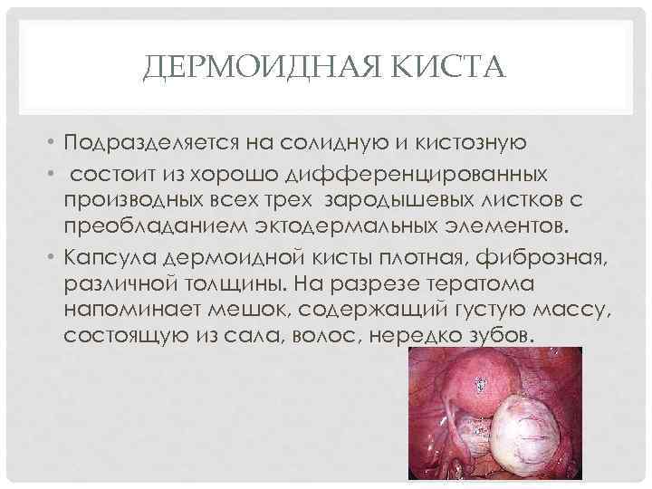 ДЕРМОИДНАЯ КИСТА • Подразделяется на солидную и кистозную • состоит из хорошо дифференцированных производных