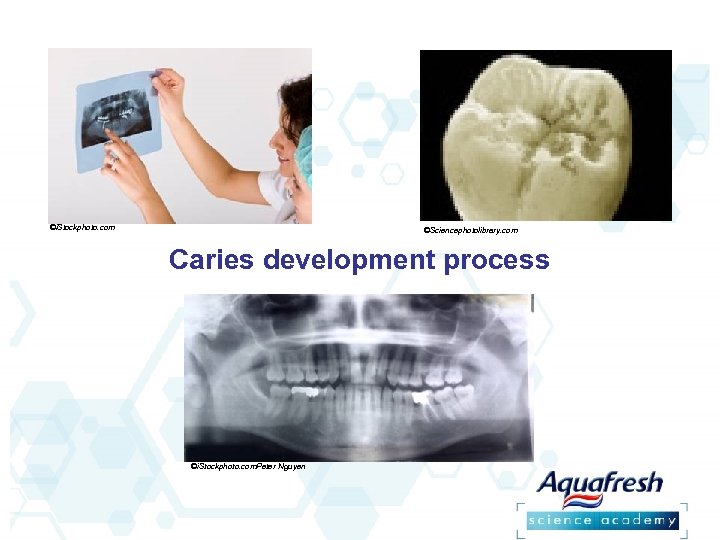 ©i. Stockphoto. com ©Sciencephotolibrary. com Caries development process ©i. Stockphoto. com. Peter Nguyen 