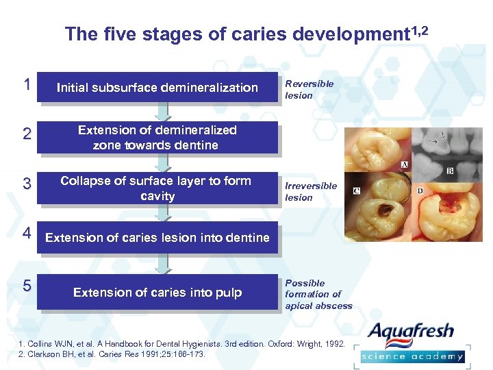 The five stages of caries development 1, 2 1 Initial subsurface demineralization 1. Initial