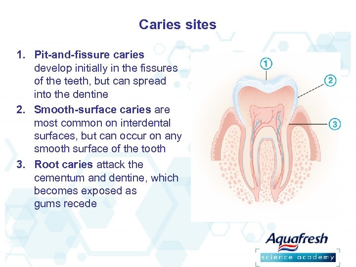 Caries sites 1. Pit-and-fissure caries develop initially in the fissures of the teeth, but