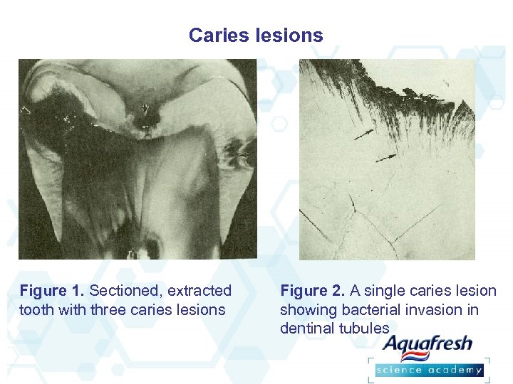 Caries lesions Figure 1. Sectioned, extracted tooth with three caries lesions Figure 2. A