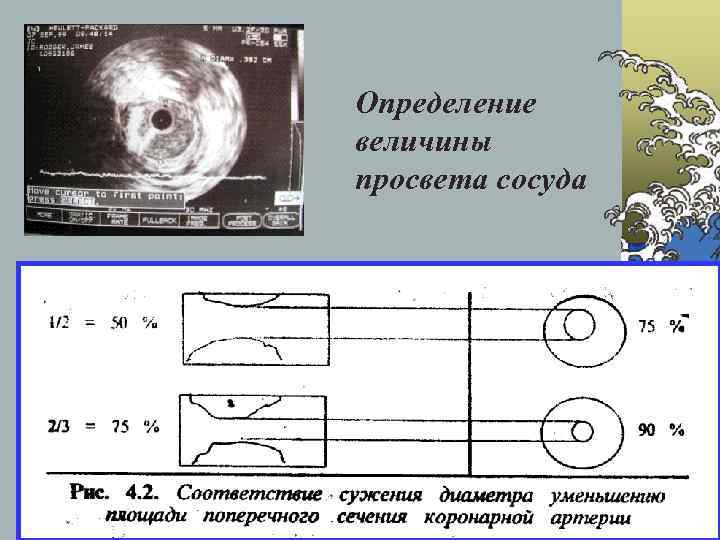 Определение величины просвета сосуда 