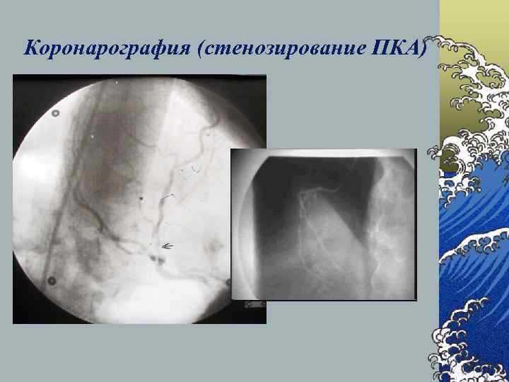 Коронарография это. Современная коронарография. Ангиография и коронарография отличия. Коронарография статистика.