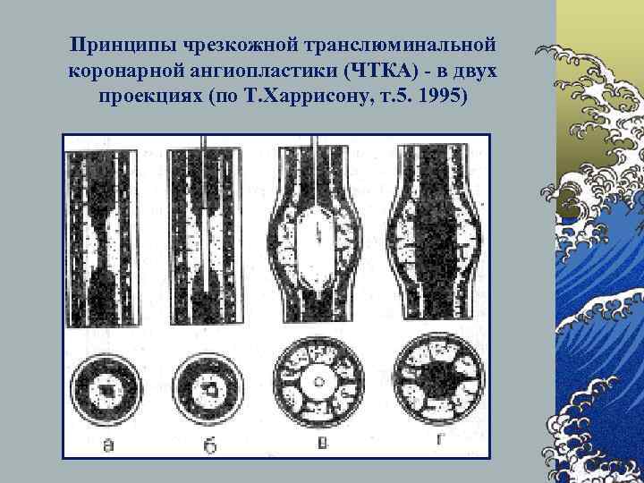 Принципы чрезкожной транслюминальной коронарной ангиопластики (ЧТКА) - в двух проекциях (по Т. Харрисону, т.