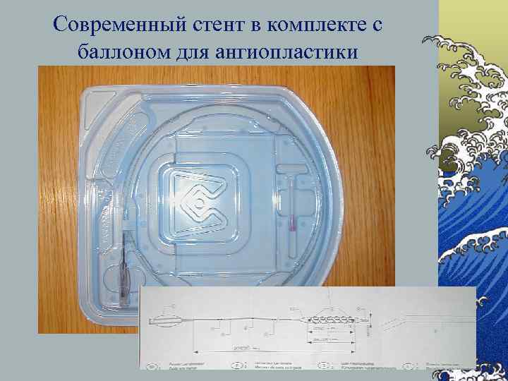 Современный стент в комплекте с баллоном для ангиопластики 