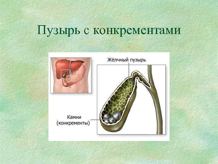 Пузырь с конкрементами 