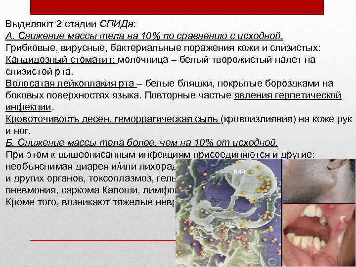Выделяют 2 стадии СПИДа: А. Снижение массы тела на 10% по сравнению с исходной.