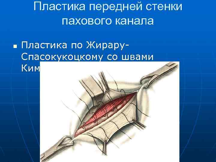 Пластика передней стенки пахового канала n Пластика по Жирару. Спасокукоцкому со швами Кимбаровского 