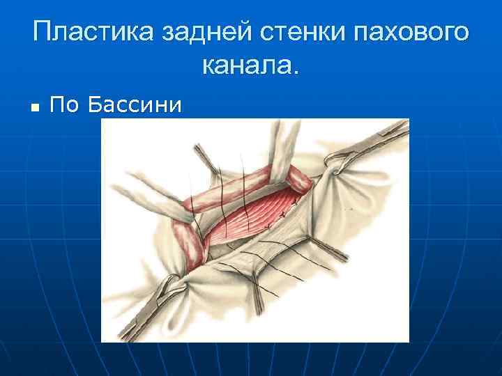 Пластика задней стенки пахового канала. n По Бассини 