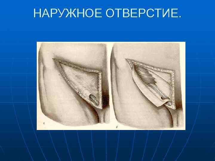 НАРУЖНОЕ ОТВЕРСТИЕ. 