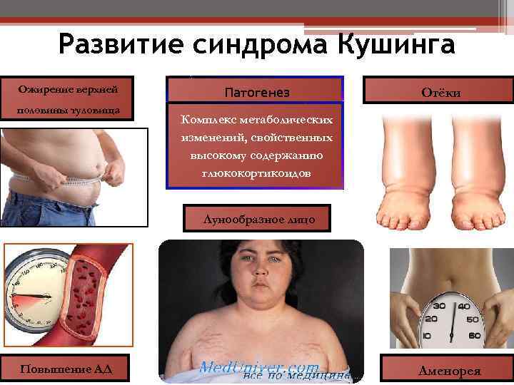 Развитие синдрома Кушинга Ожирение верхней половины туловища Патогенез Отёки Комплекс метаболических изменений, свойственных высокому