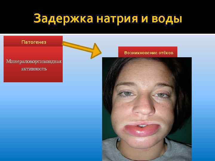 Задержка натрия и воды Патогенез Возникновение отёков Минералокортикоидная активность 