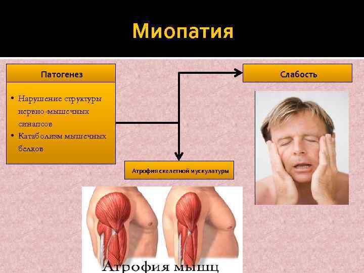 Миопатия Патогенез Слабость • Нарушение структуры нервно-мышечных синапсов • Катаболизм мышечных белков Атрофия скелетной