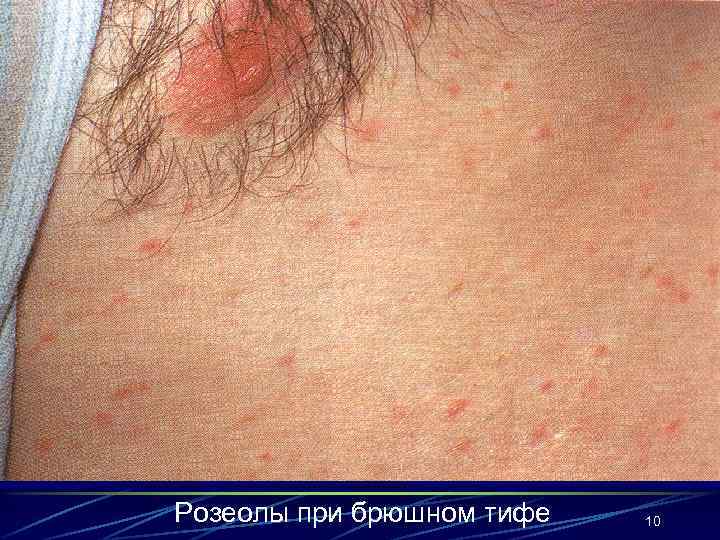 Розеолы при брюшном тифе 10 