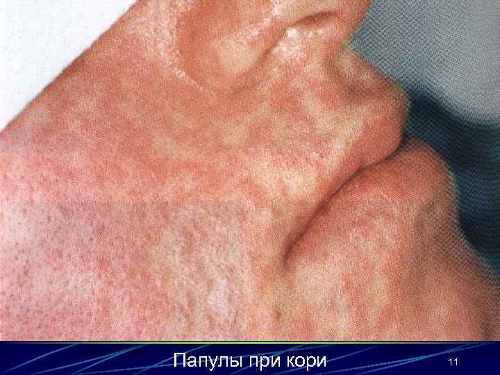 Папулы при кори 11 