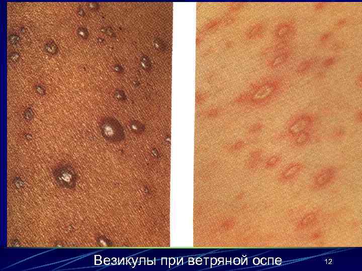 Везикулы при ветряной оспе 12 