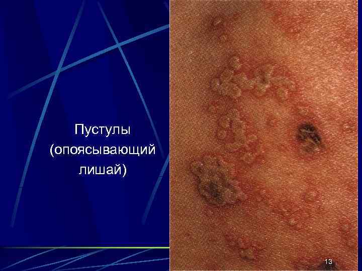 Пустулы (опоясывающий лишай) 13 