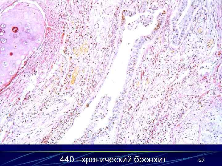 440 –хронический бронхит 20 