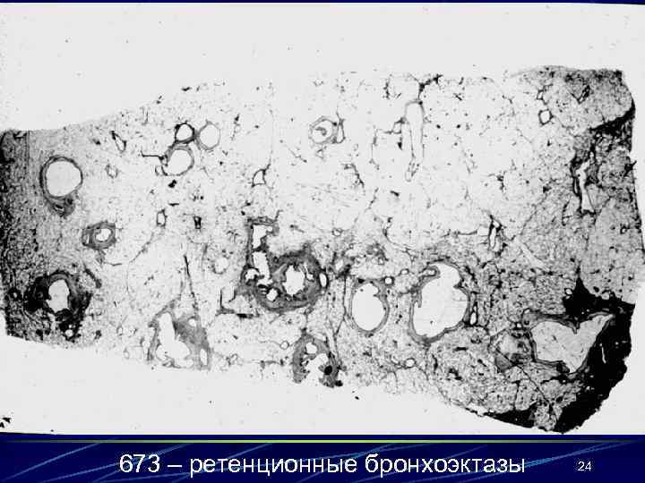 673 – ретенционные бронхоэктазы 24 