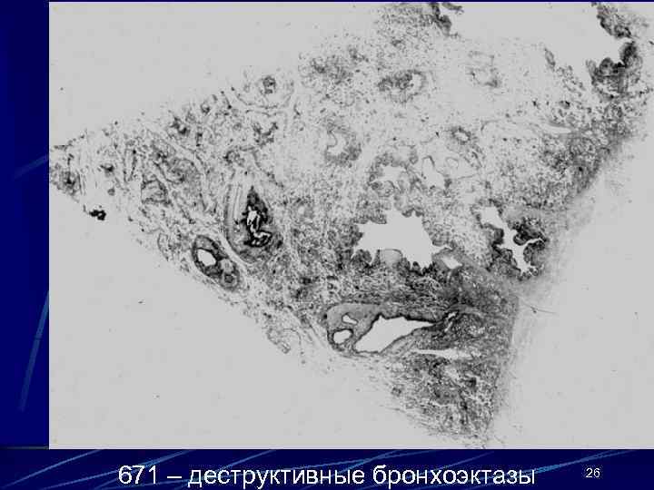 671 – деструктивные бронхоэктазы 26 
