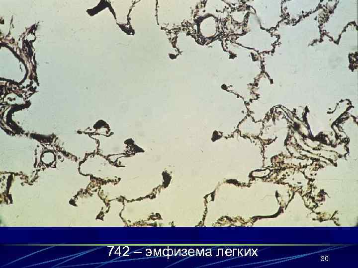 742 – эмфизема легких 30 