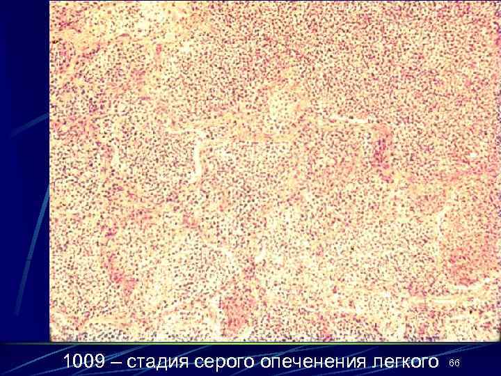 1009 – стадия серого опеченения легкого 66 