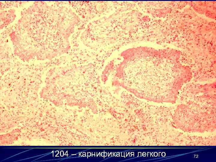 1204 – карнификация легкого 72 