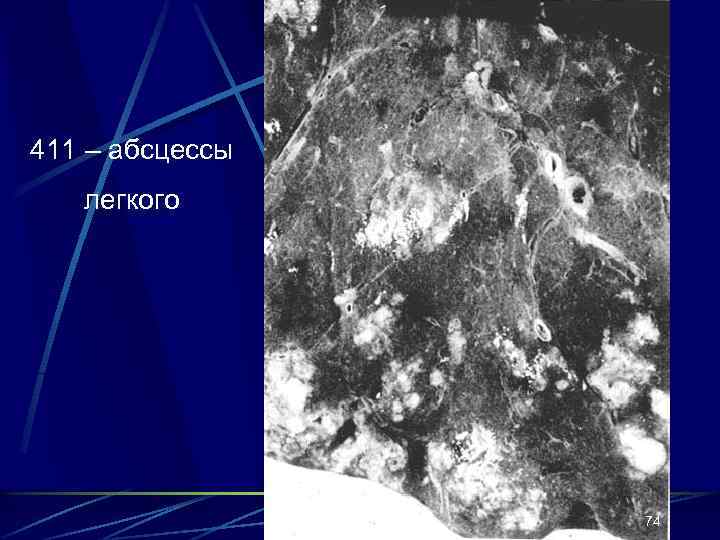 411 – абсцессы легкого 74 
