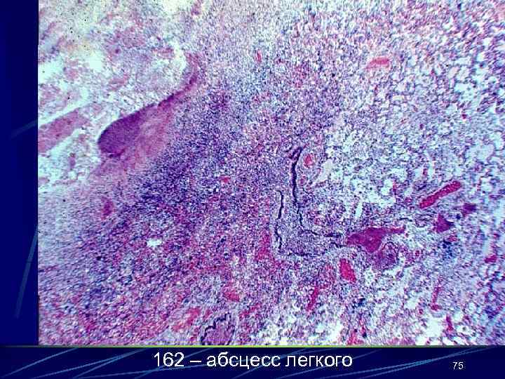 162 – абсцесс легкого 75 