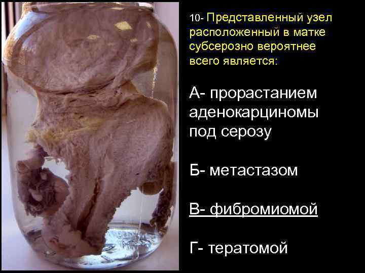 10 - Представленный узел расположенный в матке субсерозно вероятнее всего является: А- прорастанием аденокарциномы