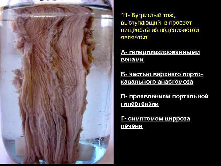 11 - Бугристый тяж, выступающий в просвет пищевода из подслизистой является: А- гиперплазированными венами