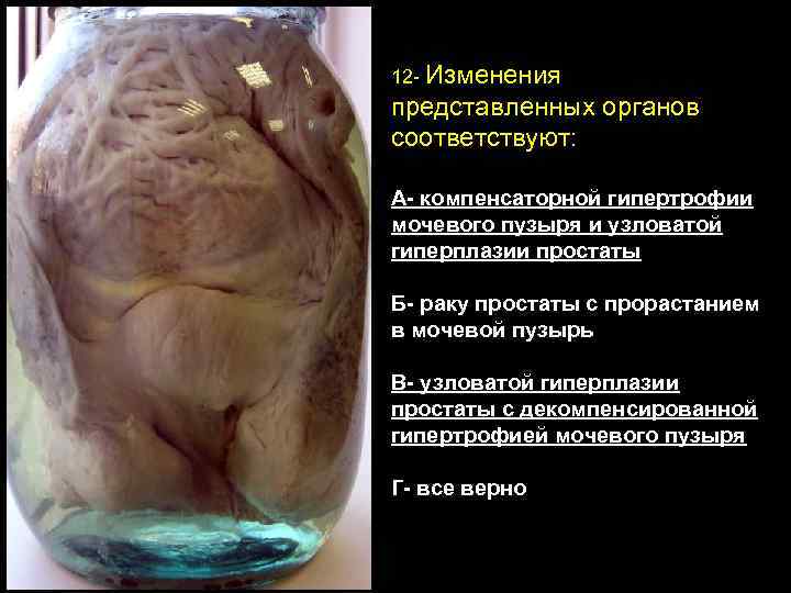 12 - Изменения представленных органов соответствуют: А- компенсаторной гипертрофии мочевого пузыря и узловатой гиперплазии