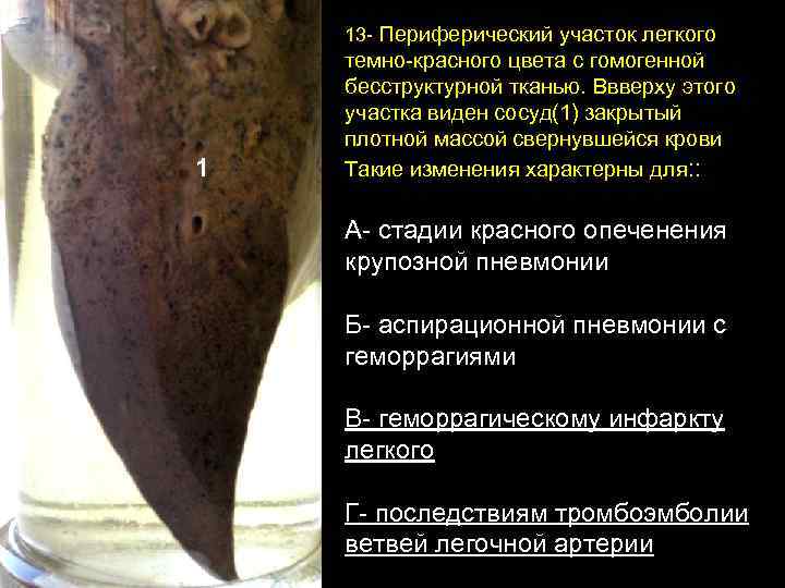 13 - Периферический участок легкого 1 темно-красного цвета с гомогенной бесструктурной тканью. Ввверху этого
