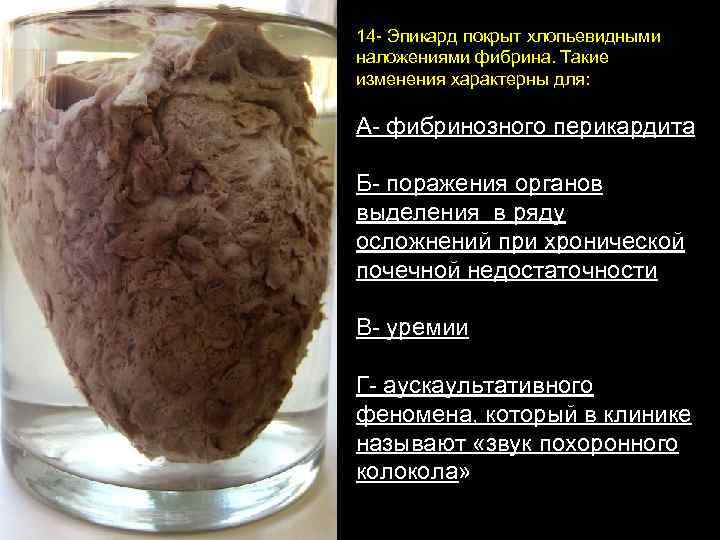 14 - Эпикард покрыт хлопьевидными наложениями фибрина. Такие изменения характерны для: А- фибринозного перикардита