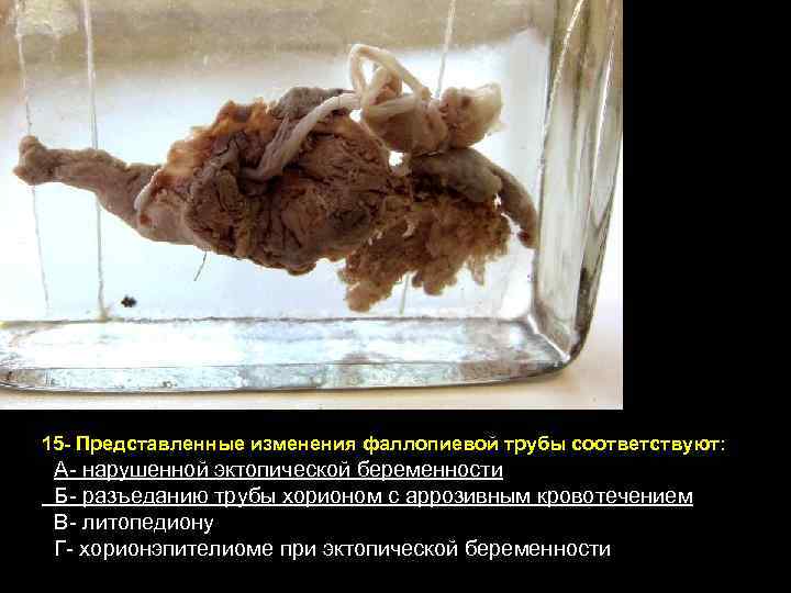 15 - Представленные изменения фаллопиевой трубы соответствуют: А- нарушенной эктопической беременности Б- разъеданию трубы