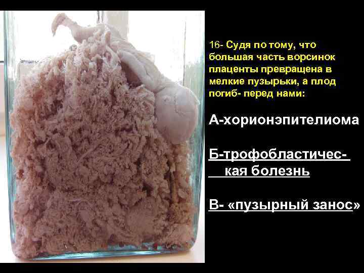 16 - Судя по тому, что большая часть ворсинок плаценты превращена в мелкие пузырьки,