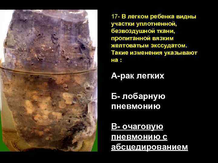 17 - В легком ребенка видны участки уплотненной, безвоздушной ткани, пропитанной вязким желтоватым экссудатом.